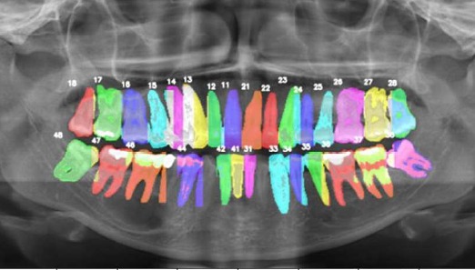 Visualization of instance segmentation of teeth